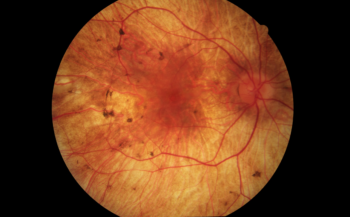 CHM color picture of the retina