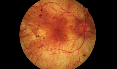 Choroideremia Research Is Necessary to Help Prevent Blindness at an Early Age